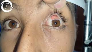 Ophthalmic Signs Anterior Segment [upl. by Annodahs173]