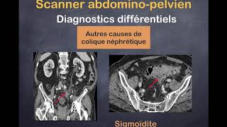 Lithiase Urinaire  3 Diagostics différentiels [upl. by Sabine]