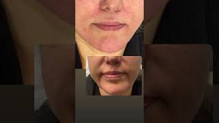 Effective Corner Lip Lift with FullFace Filler Injection by Dr Sanaz Amiri [upl. by Simdars]