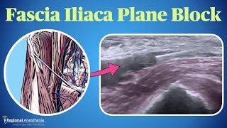 Fascia Iliaca Plane Block [upl. by Aelyak]