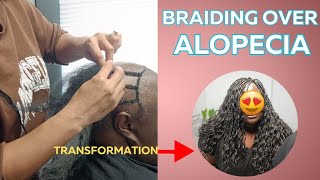 How to Braid hair over ALOPECIA  Alopecia Hairstyles jamithestylist alopecia [upl. by Lled617]