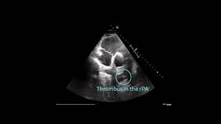 〖Echocardiography〗 Acute pulmonary embolism with a thrombus in the right pulmonary artery 🏥 [upl. by Las]