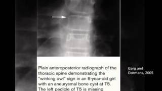 Benign Bone Lesions by Dr Jack Pang [upl. by Alue60]