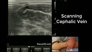 Scanning the Cephalic Vein with Ultrasound [upl. by Eardna]