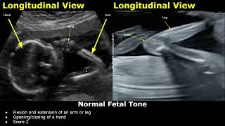 Fetal Biophysical Profile Ultrasound Normal Vs Abnormal Values  Fetus BreathingTone BPSBPP USG [upl. by Gass]