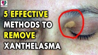 5 Effective Methods to Remove Xanthelasma  Best Health Tips for CHRONIC DISEASES [upl. by Ynatsyd]