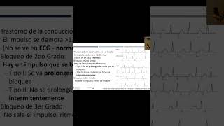 ¿Qué es el bloqueo sinoatrial y cómo afecta al ritmo cardíaco Dr Sebastián Moreno M [upl. by Ispep]