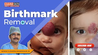 Birthmark Removal  Laser Treatment For Removing Of Birthmark  DrNKailash  Clear Skin Kurnool [upl. by Enaasiali]