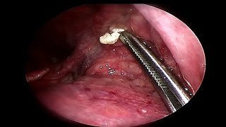 Removing LARGE Tonsil Stone  Doctor Anh [upl. by Chaffee744]