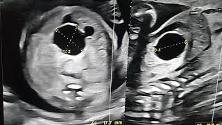 FETAL CHOLEDOCHAL CYST TEACHING BY DR PRADEEP UNDER REFER SERIES [upl. by Eikceb764]