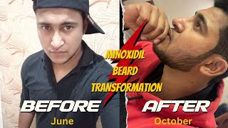 6 Month Beard Transformation with Minoxidil Before and After [upl. by Ydiarf254]