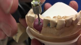 Neodent implant placed on an angle NeoDent tryin abutment kit 17 degree angulated abutment [upl. by Haniraz550]