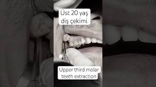 Upper third molar teeth extraction dentist smiledesigndental side sidedentist [upl. by Trebloc155]