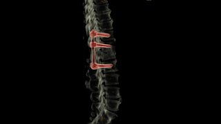 Pedicle Screw Fixation of Lumbar body Compression Fracture [upl. by Flatto627]