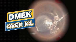 DMEK over ICL [upl. by Faxan]