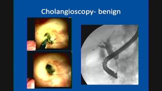 Primary Sclerosing Cholangitis Update in Management [upl. by Aremus]