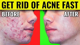 Say Goodbye to Acne Dr Bergs Proven Methods for Clearing Your Skin [upl. by Colis337]