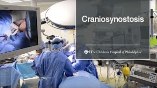 What Is Craniosynostosis 6 of 9 [upl. by Zachery]