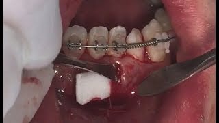 Treatment of gingival recession with Collagen graft  Prof Sungtae Kim [upl. by Elicec]