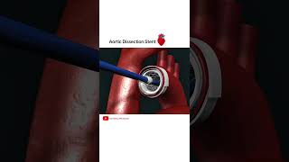 Aortic dissection Stent grafting cardiology shorts [upl. by Hilario]