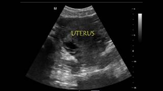 Extended  Rapid Ultrasound for Shock and Hypotension [upl. by Zillah]