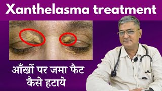 Xanthelasma Eye cholesterol kam karne ke upay  eye cholesterol treatment  Xanthelasma removal [upl. by Fee400]