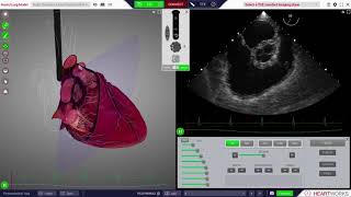 HeartWorks Right coronary artery regional wall motion abnormality [upl. by Alguire]