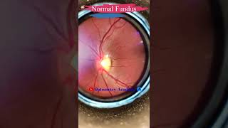 Normal fundus  Normal Retina  Smartphone Fundus Videography  Fundus Photography  Short Video 88 [upl. by Ahsiei]