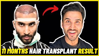 11 Months Hair Transplant Result  I am Shocked  Medications used in 11 months  Finasteride quit [upl. by Garrot82]