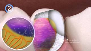 Dental Bonding of Ceramic Inlays [upl. by Derna]