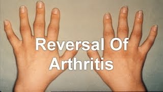 Reversing Arthritis  Reversal Of Arthritis [upl. by Nebra]