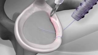 Knotless Shoulder Labral Repair with Arthrex® PushLock® [upl. by Gnouc308]