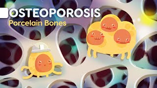 Osteoporosis symptoms and causes  Everything you need to know explained easily [upl. by Dnamra]