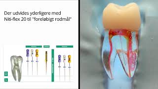 Traditional glidepath management with Kflex and xray calibration [upl. by Euqnom]