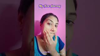 Acne Heal Journey acne acnetreatment acneremoval acnescars acnejourney shorts youtubeshorts [upl. by Eltsyrk]