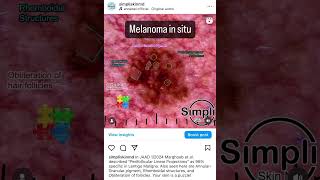 Melanoma in situ [upl. by Sew]