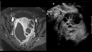 15casepelvicGUgenitourinaryfemaleimagingRenalbladderUSCTMRIRadiologyradiopediafrcrtip [upl. by Lillis]