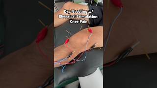 Healing KNEE PAIN with Needles  Electrical Stimulation physicaltherapy [upl. by Rraval906]