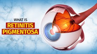 What is Retinitis Pigmentosa RP  Symptoms Treatment and More [upl. by Noskcaj]