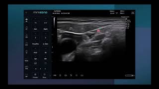 Ultrasound guided IJV central line insertion [upl. by Lyssa432]