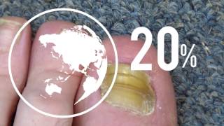 Safe and Effective Nail Fungus Treatment  Complete Video Guide [upl. by Evelyn272]