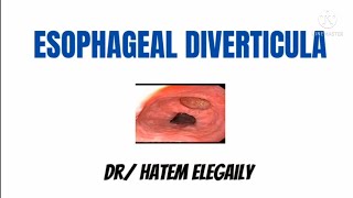 Esophageal Diverticula [upl. by Innos]