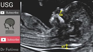 Fetal Nuchal translucency amp Nuchal fold ultrasound by DrFatima [upl. by Eiwoh]