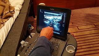 Ultrasound guided stellate ganglion block by Rafael Blanco at JCRAC19 [upl. by Orji749]