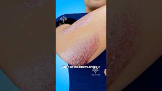 How Does Psoriasis Happen shorts viralvideo skincare  Creativelearning3d [upl. by Britt]