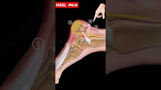 understanding the causes of heel pain comprehensive review in shorts [upl. by Faucher]