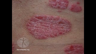 Case Discussion  1  skin rash [upl. by Dietrich]