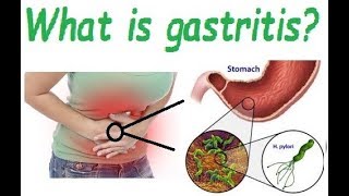 What is gastritis Causes and symptoms of gastritis [upl. by Orsa]