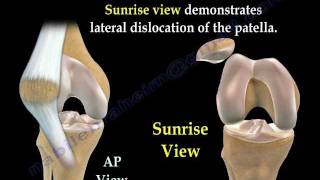 Patellar Dislocations  Everything You Need To Know  Dr Nabil Ebraheim [upl. by Sunda]