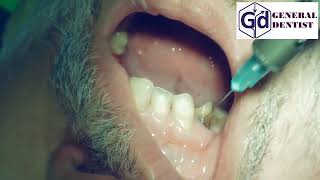 Infiltration anesthesia for treatment 1112 teeth [upl. by Bathsheba]